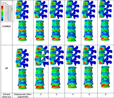 Effect of cement volume on biomechanical response of a spine segment treated with a PEEK polymer implant: a finite element comparative study with vertebroplasty